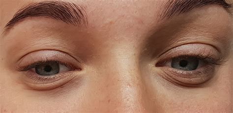 Bags Under Eyes These Are Your Best Bets For Eye Bag Treatment