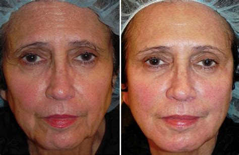 Pin By Adam Scheiner Md On Sculptra Facial Rejuvenation Facial