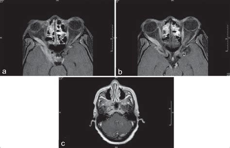 T 1 Axial Magnetic Resonance Imaging Post Gadolinium Contrast At The