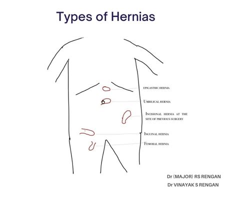 Different Types Of Hernias Dr Rengans Surgical Centre
