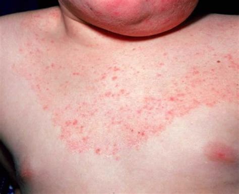 Ringworm In Babies Causes Signs Symptoms Diagnosis And Treatment