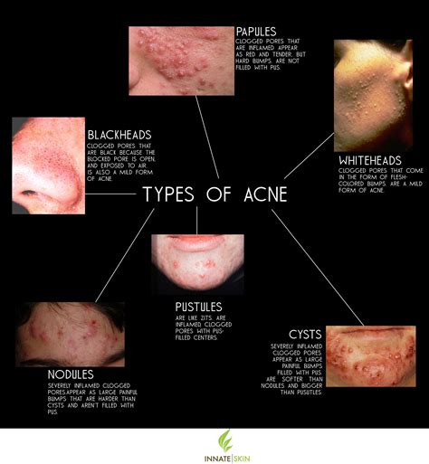 Pimple Treatment And Acne Treatment Dr Harold Ma