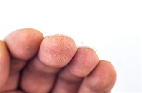 Mild Dyshidrotic Eczema Fingers