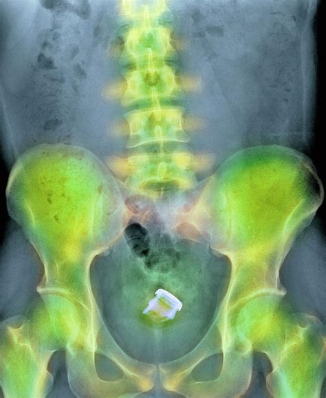 Drinks Bottle In Man S Rectum Photograph By Du Cane Medical Imaging Ltd Science Photo Library