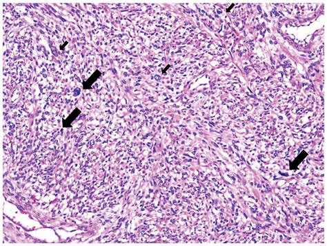 Locally‑advanced Unresected Uterine Leiomyosarcoma With Triple‑modality
