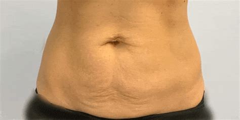 Tummy Tuck Before After Albany Laser Cosmetic Medical Spa