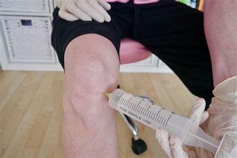 How To Do Subcutaneous Ozone Knee Injections The Power Of Ozone