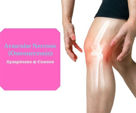 Avascular Necrosis Osteonecrosis Symptoms And Causes