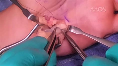 AAOS OVT Hook Of Hamate Excision For Symptomatic Nonunion