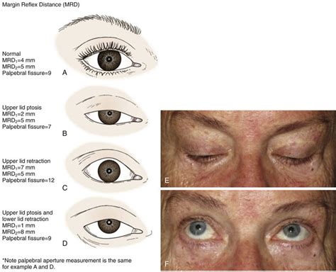 Upper Eyelid Ptosis And Retraction Ento Key