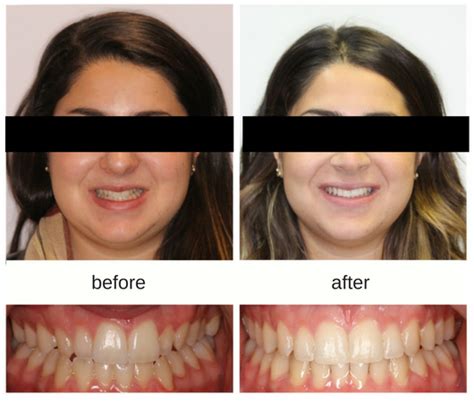 Teen Invisalign And Braces Before And After Hometown Orthodontics