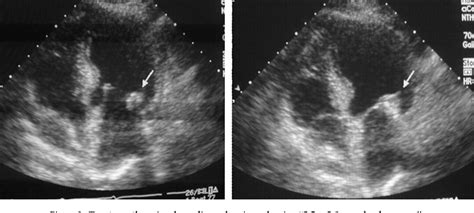 Figure 2 From Caseous Mitral Annular Calcification Is It A Benign