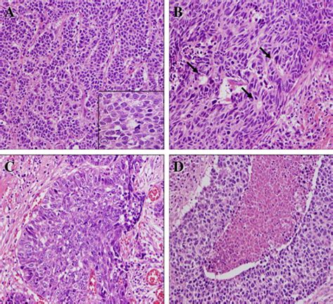 Histological Findings Of Mucosal Large Cell Neuroendocrine Carcinoma