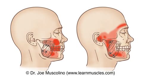 Masseter Trigger Points Learn Muscles