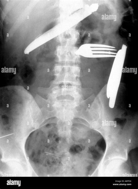 X Ray Swallowed Foreign Bodies Stock Photo Alamy