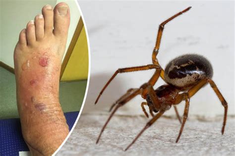 False Widow Spider Bite Infection ~ Spider Widow False Bite Reaction