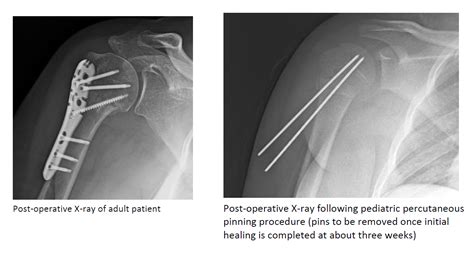 Classification Of Proximal Humeral Fractures Based On