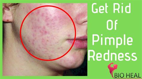How To Get Rid Of Pimples Redness The Ultimate Guide Bioheal Youtube