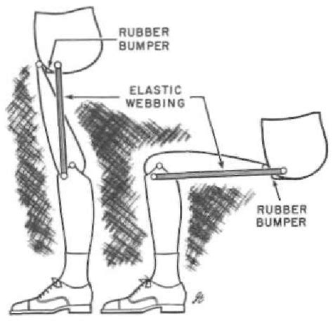Figure 8 From The Evolution Of The Canadian Type Hip Disarticulation