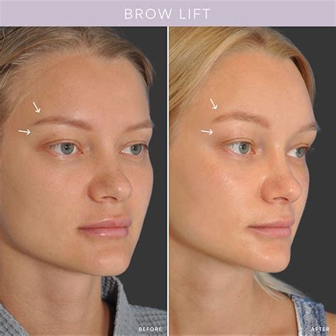 Botox Eyebrow Lift Non Surgical Brow Lift London And Bucks Non
