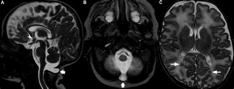 Incidental Findings On Routine Brain Mri Scans In Preterm Infants Adc