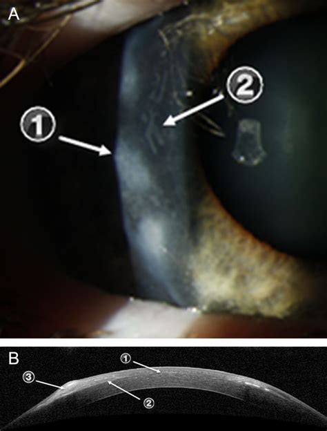 Salzmann Nodular Degeneration Associated With Epithelial Ingrowth After