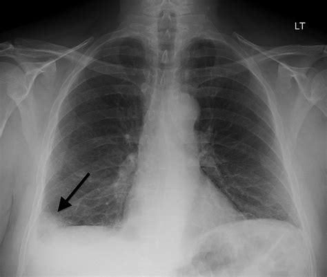 Radiographic Features Of Pulmonary Embolism Hamptons Hump