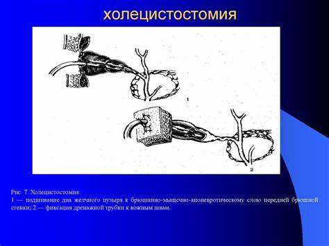 Острый холецистит диеты Желчекаменная болезнь. Острый холецистит - online presentation Желчекаменная болезнь. Острый холецистит - online presentation Острый холецистит диеты