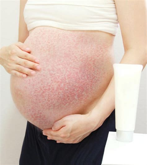 Pregnancy Rash On Belly And Legs Printable Templates Protal
