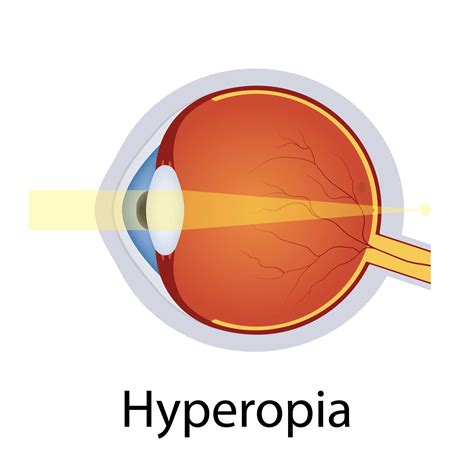 What Is The Difference Between Myopia Hyperopia And Presbyopia New