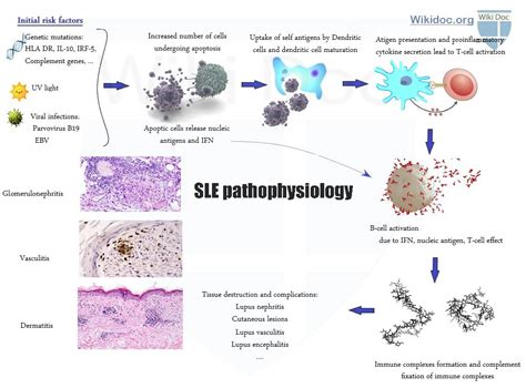 Systemic Lupus Erythematosus Pathophysiology Wikidoc