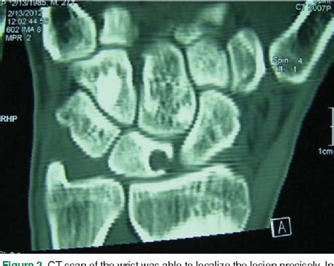 Pdf Lunate Intraosseous Ganglion Cysts And Chronic Wrist Pain Reporting Six Cases Semantic