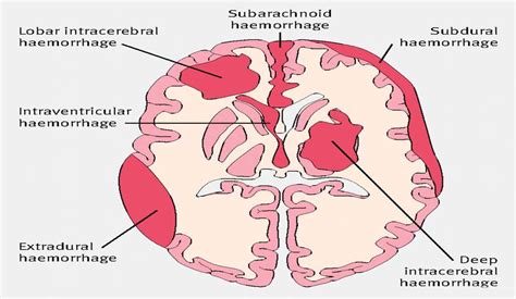 10 Details That You Must Know About Intracranial Hemorrhage Louie