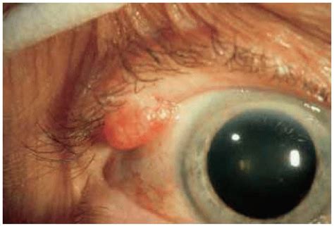 Benign Tumors Of The Eyelid Epidermis Ento Key