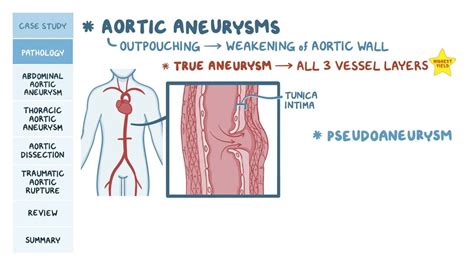 Aortic Pathologies Explained Aortic Aneurysm Aneurysm Aortic My XXX
