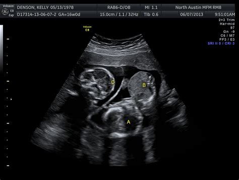 The Texas Trio A Triplet Pregnancy Blog 16 Week Ultrasound Pics