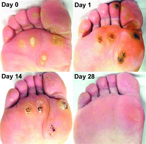 Plantar Warts Had A Complete Response To Ala Pdt These Warts Were
