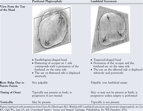 Positional Plagiocephaly Vs Lamboid Synostosis Diagnosis Treatment