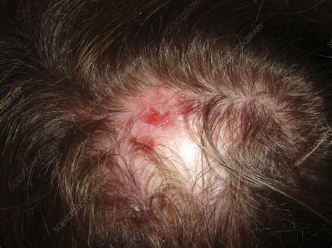 Alopecia Areata In Lupus Erythematosus Stock Image C0549601