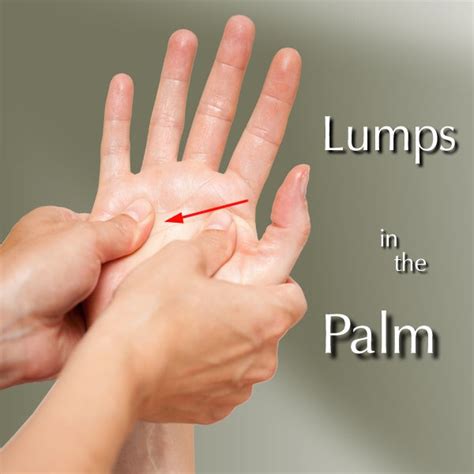 Effectuer Renforcer Manuel Small Lump On Palm Of Hand Convoquer