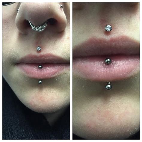 Loranshumway On Instagram “check Out This Healed Philtrum And Vertical