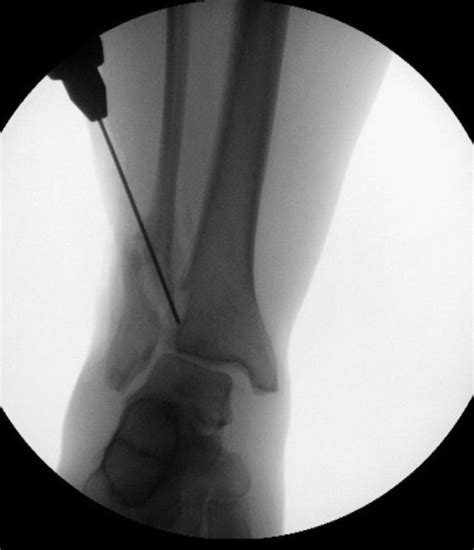 Treatment Of Distal Fibular Malunion With Corrective Osteotomy Yablon