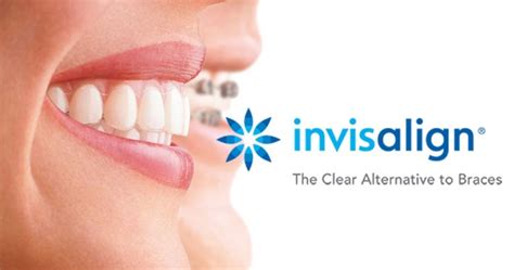 Bunn Orthodontic Group Blog The Choice Is Clear With Invisalign