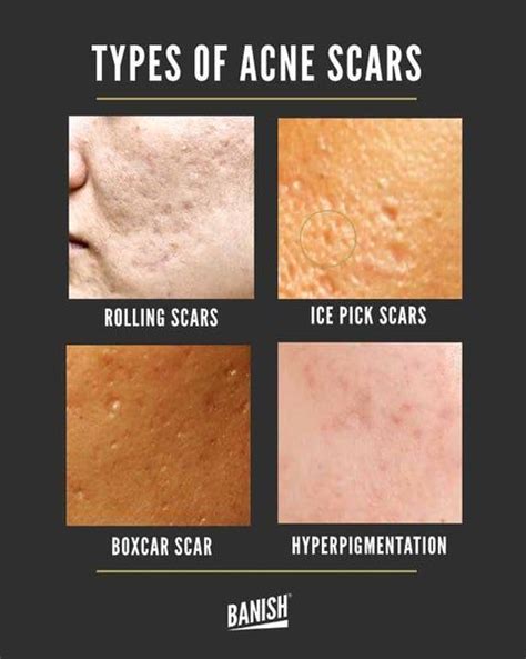 How To Get Rid Of Acne Scars Fast What Actually Works Acne Pit Scars