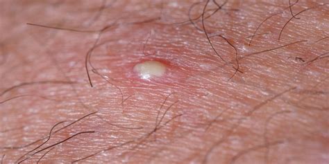 How To Tell The Difference Between Ingrown Hair And Herpes How To Tell