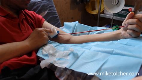 How To Remove Needle From Fistula After Dialysis YouTube