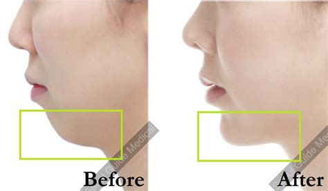 Genioplasty Your Guide To Chin Surgery In South Korea ソウルガイドメディカル