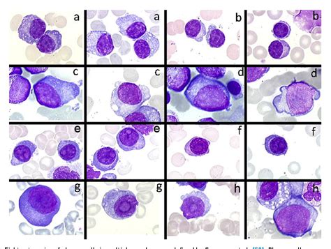 Figure 7 From Plasma Cell Morphology In Multiple Myeloma And Related