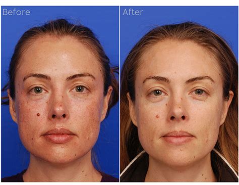 Ipl Treatments San Diego — Sky Facial Plastic Surgery