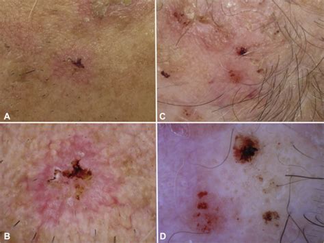 Evaluation Of Dermatoscopic Criteria For Early Detection Of Squamous